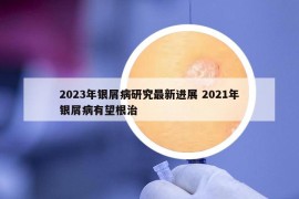 2023年銀屑病研究最新進展 2021年銀屑病有望根治