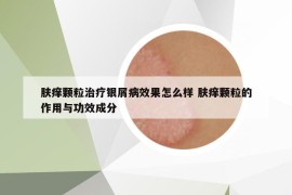 膚癢顆粒治療銀屑病效果怎么樣 膚癢顆粒的作用與功效成分