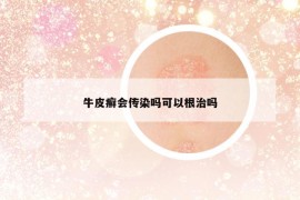 牛皮癬會傳染嗎可以根治嗎