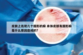 皮膚上出現(xiàn)幾個(gè)圓形的癬 身體皮膚有圓形癬是什么原因造成的?