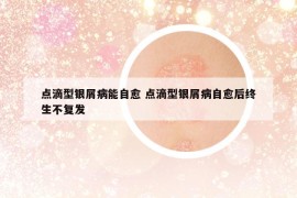點滴型銀屑病能自愈 點滴型銀屑病自愈后終生不復發(fā)