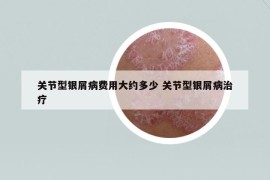 關節(jié)型銀屑病費用大約多少 關節(jié)型銀屑病治療