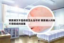 銀屑病又不是癌癥怎么治不好 銀屑病人終身不得癌癥的因果