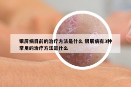 銀屑病目前的治療方法是什么 銀屑病有3種常用的治療方法是什么