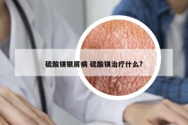 硫酸鎂銀屑病 硫酸鎂治療什么?