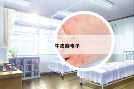牛皮癬電子