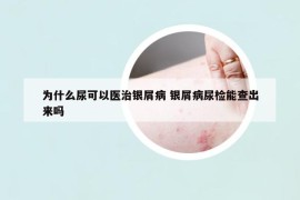 為什么尿可以醫(yī)治銀屑病 銀屑病尿檢能查出來(lái)嗎