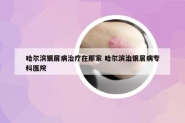 哈爾濱銀屑病治療在那家 哈爾濱治銀屑病?？漆t(yī)院