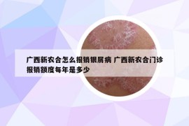 廣西新農(nóng)合怎么報銷銀屑病 廣西新農(nóng)合門診報銷額度每年是多少