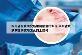 四川省皮膚研究所銀屑病治療如何 四川省皮膚病性研究所怎么網(wǎng)上掛號(hào)