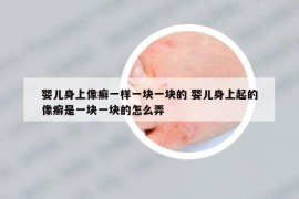 嬰兒身上像癬一樣一塊一塊的 嬰兒身上起的像癬是一塊一塊的怎么弄