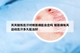 天天鍛煉出汗對(duì)銀屑病能自愈嗎 銀屑病每天運(yùn)動(dòng)出汗多久能治好