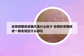白斑初期癥狀圖片是什么樣子 白斑的早期癥狀一般出現(xiàn)在什么部位