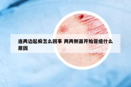 連兩邊起癬怎么回事 兩兩側(cè)面開始冒痘什么原因