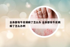 全身都有牛皮病癬了怎么辦 全身都有牛皮病癬了怎么辦啊