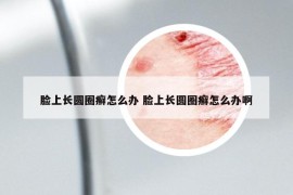 臉上長(zhǎng)圓圈癬怎么辦 臉上長(zhǎng)圓圈癬怎么辦啊