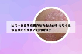 沈陽中北銀屑病研究院有去過的嗎 沈陽中北銀屑病研究院有去過的嗎知乎