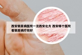 西安銀屑病醫(yī)院一流西安北方 西安哪個醫(yī)院看銀屑病療效好