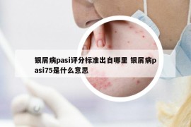 銀屑病pasi評(píng)分標(biāo)準(zhǔn)出自哪里 銀屑病pasi75是什么意思