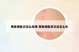銀屑病色沉怎么處理 銀屑病色素沉淀怎么辦