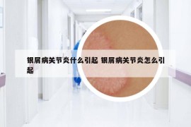 銀屑病關(guān)節(jié)炎什么引起 銀屑病關(guān)節(jié)炎怎么引起