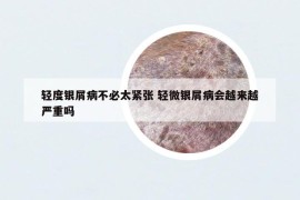 輕度銀屑病不必太緊張 輕微銀屑病會(huì)越來越嚴(yán)重嗎