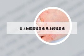 頭上長屑是銀屑病 頭上起銀屑病