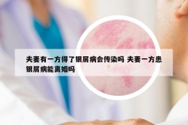 夫妻有一方得了銀屑病會傳染嗎 夫妻一方患銀屑病能離婚嗎