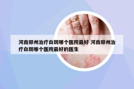 河南鄭州治療白斑哪個醫(yī)院最好 河南鄭州治療白斑哪個醫(yī)院最好的醫(yī)生
