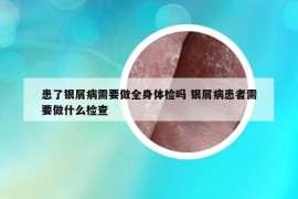 患了銀屑病需要做全身體檢嗎 銀屑病患者需要做什么檢查