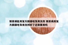 銀屑病能用復方酮康唑發(fā)用洗劑 銀屑病用復方酮康唑發(fā)用洗劑好了還需要用嗎