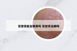 百想膏能治銀屑嗎 百想膏治癬嗎