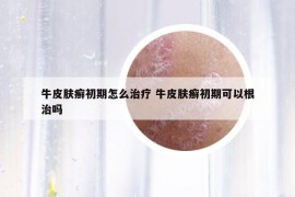 牛皮膚癬初期怎么治療 牛皮膚癬初期可以根治嗎
