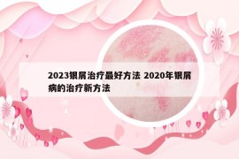 2023銀屑治療最好方法 2020年銀屑病的治療新方法