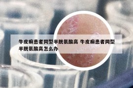 牛皮癬患者同型半胱氨酸高 牛皮癬患者同型半胱氨酸高怎么辦