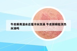 牛皮癬用溫水還是冷水洗澡 牛皮膚癬能洗熱水澡嗎