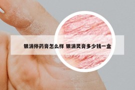 銀消停藥膏怎么樣 銀消靈膏多少錢(qián)一盒
