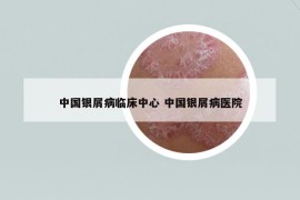 中國銀屑病臨床中心 中國銀屑病醫(yī)院