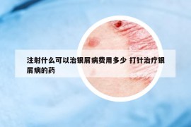 注射什么可以治銀屑病費用多少 打針治療銀屑病的藥