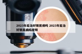 2023年能治好銀屑病嗎 2023年能治好銀屑病嗎視頻