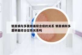 銀屑病與多囊卵巢綜合癥的關(guān)系 銀屑病和多囊卵巢綜合征有關(guān)系嗎