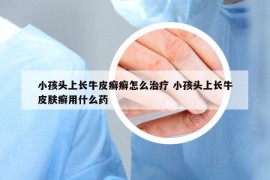 小孩頭上長牛皮癬癬怎么治療 小孩頭上長牛皮膚癬用什么藥