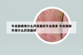 牛皮膚癬用什么藥膏最好不含激素 牛皮膚癬外用什么藥膏最好