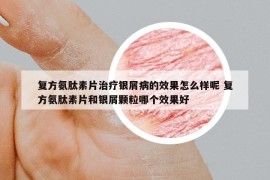 復(fù)方氨肽素片治療銀屑病的效果怎么樣呢 復(fù)方氨肽素片和銀屑顆粒哪個(gè)效果好