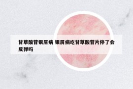 甘草酸苷銀屑病 銀屑病吃甘草酸苷片停了會(huì)反彈嗎