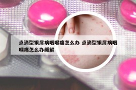 點滴型銀屑病咽喉痛怎么辦 點滴型銀屑病咽喉痛怎么辦緩解