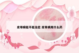 皮帶癬能不能治愈 皮帶病用什么藥