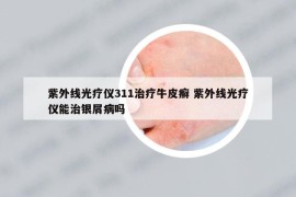 紫外線光療儀311治療牛皮癬 紫外線光療儀能治銀屑病嗎