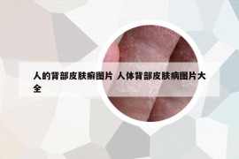 人的背部皮膚癬圖片 人體背部皮膚病圖片大全