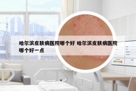 哈爾濱皮膚病醫(yī)院哪個(gè)好 哈爾濱皮膚病醫(yī)院哪個(gè)好一點(diǎn)